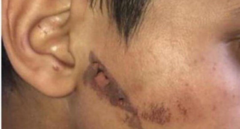 عاقب إبنه القاصر بحرق وجهه ويده… وهذا هو السبب !