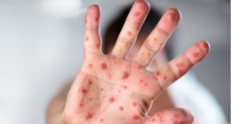 في حالة أولى من نوعها.. انتقال جدري القرود من إنسان إلى حيوان أليف