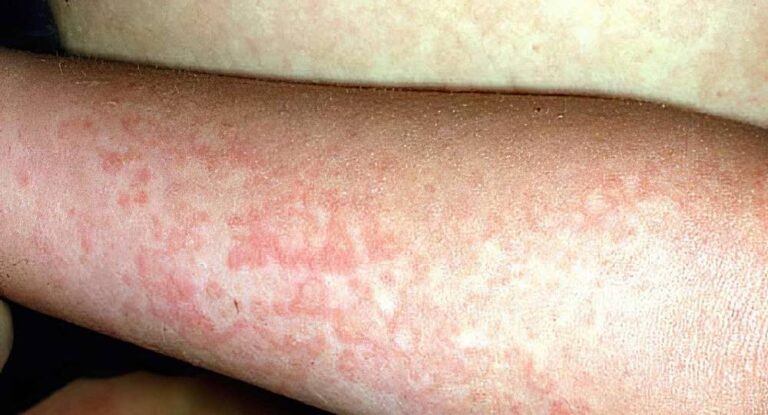 “ينتشر بسرعة في المدارس ويثير القلق”… طبيب يكشف عن Parvo B19